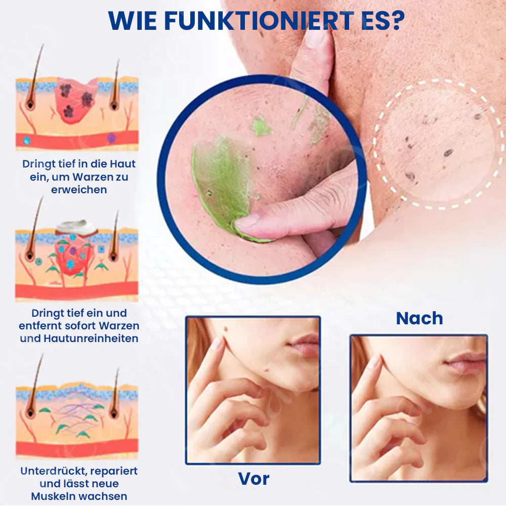 ✅ Offizieller Laden: Oveallgo® NatureErase Sofort Maulwurf & Flecken-Creme