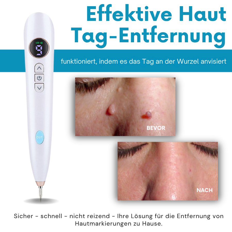 Bikenda® Heimgebrauch CO2 Laser-Schuss Ausradieren Pro