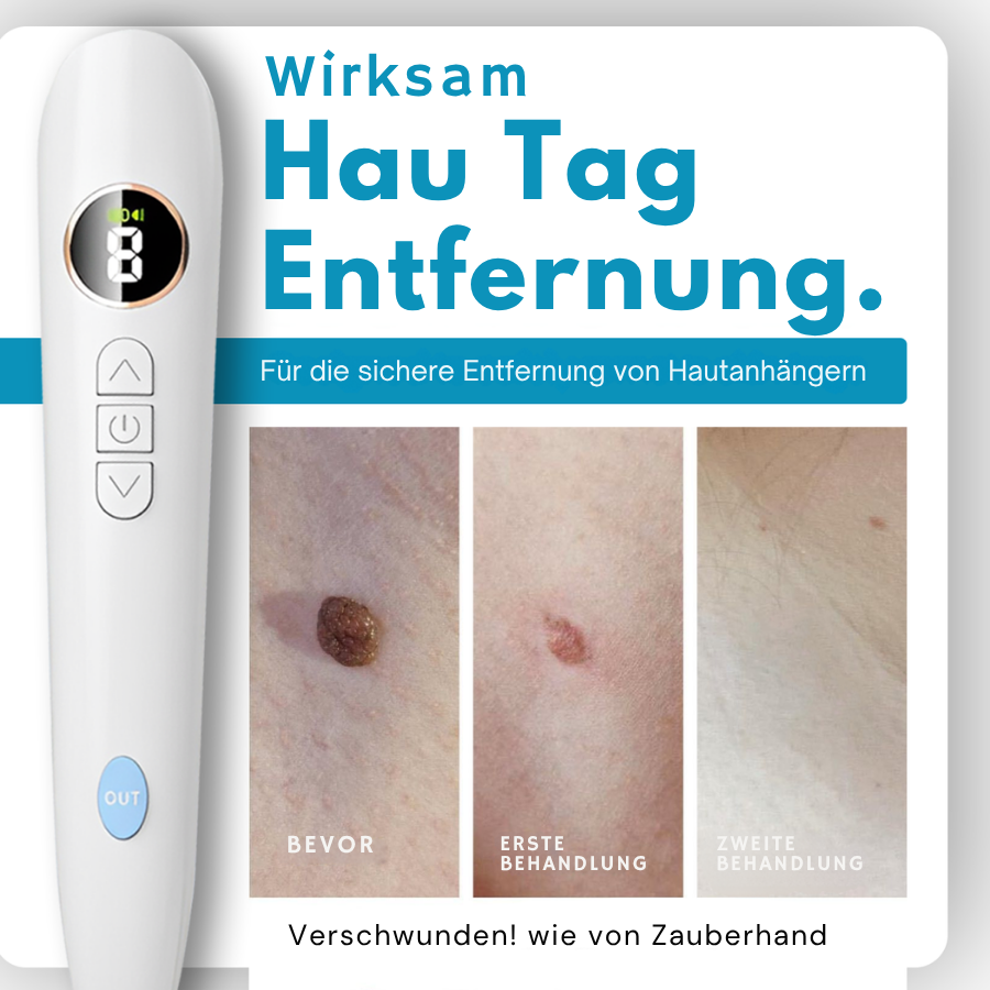 Bikenda® Heimgebrauch CO2 Laser-Schuss Ausradieren Pro