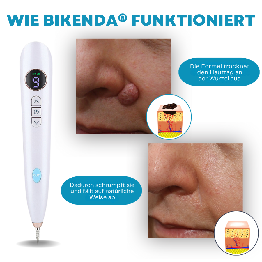 Bikenda® Heimgebrauch CO2 Laser-Schuss Ausradieren Pro