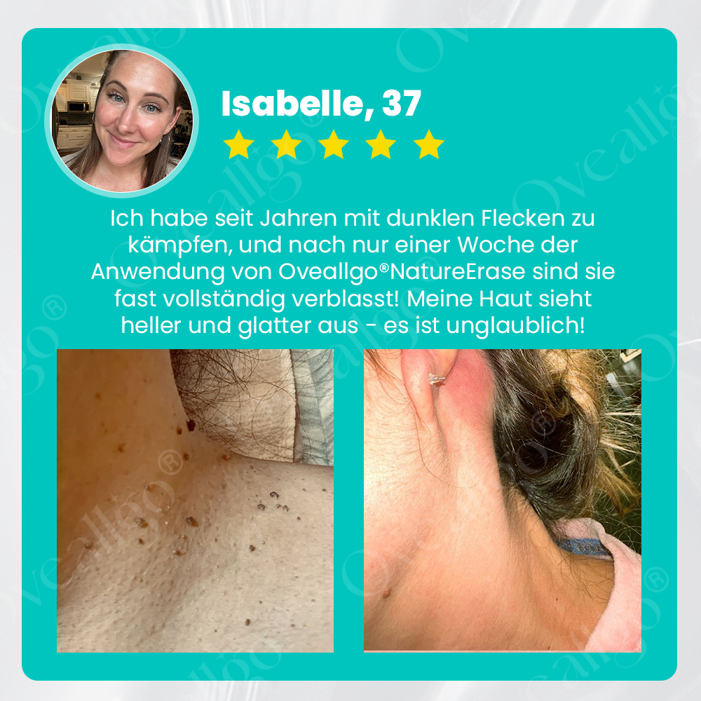 ✅ Offizieller Laden: Oveallgo® NatureErase Pro Gel zur sofortigen Entfernung von Muttermalen und Flecken