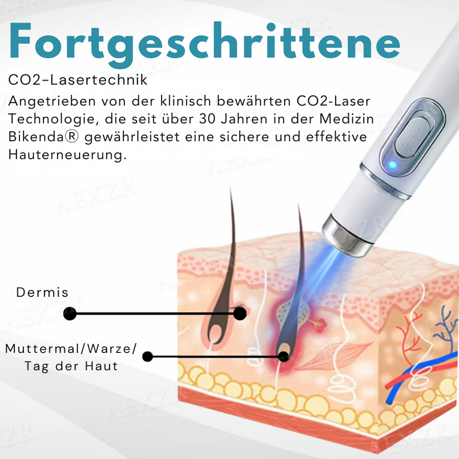Bikenda® Nicht-invasiv Leberfleck- und Warzenentfernungs-Laserstift