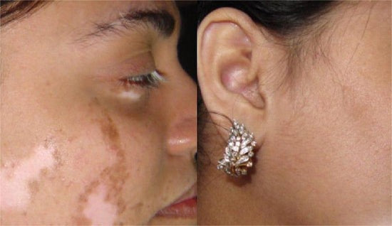 Oveallgo® VitiClear Prox Bienengift Creme 28 Oveallgo® VitiClear Prox Bienengift Creme