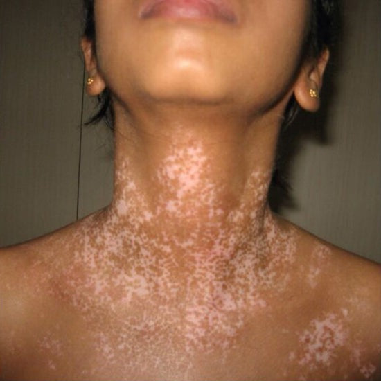 Oveallgo® VitiClear Prox Bienengift Creme 40 Oveallgo® VitiClear Prox Bienengift Creme