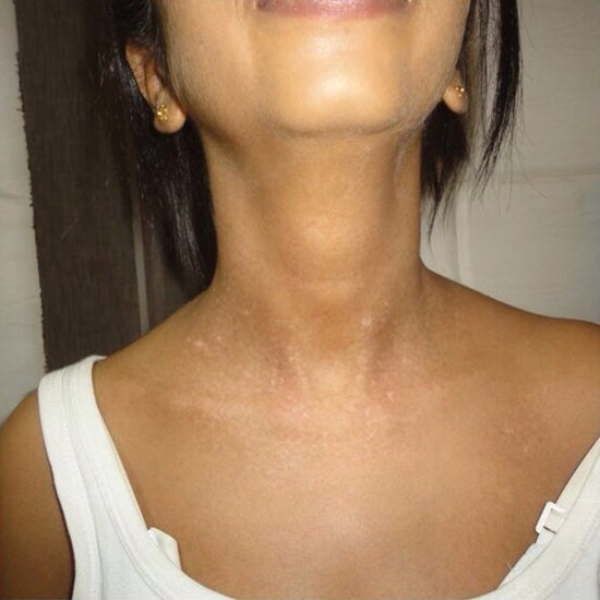 Oveallgo® VitiClear Prox Bienengift Creme 41 Oveallgo® VitiClear Prox Bienengift Creme