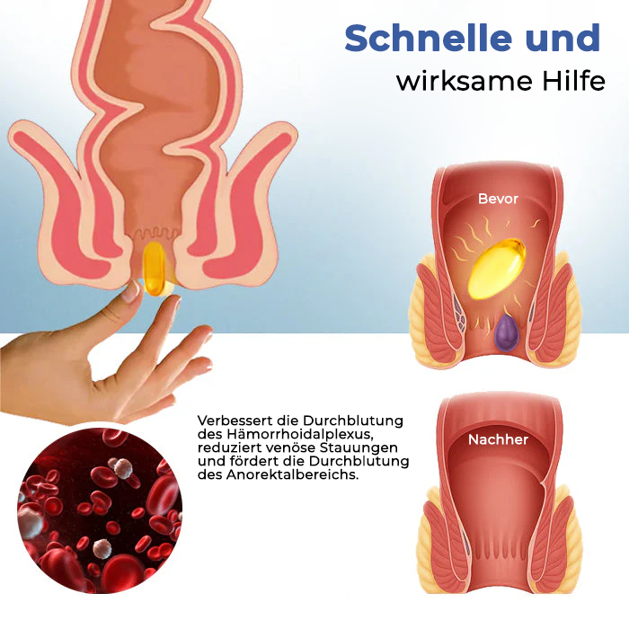 Oveallgo® Natürliche Hämorrhoiden-Kapseln