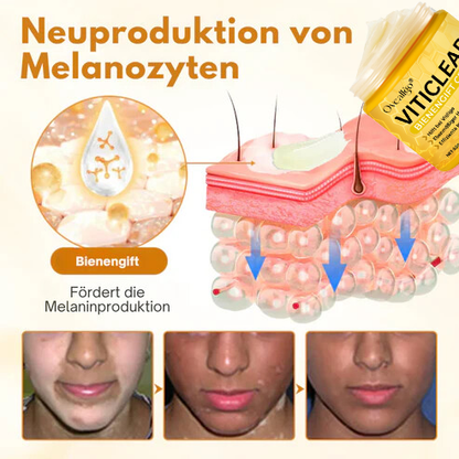 Oveallgo® VitiClear Plus Bienengift Creme